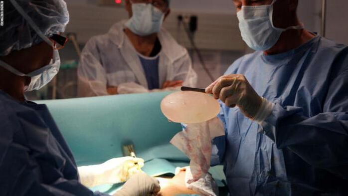 Caratteristiche della mammoplastica
