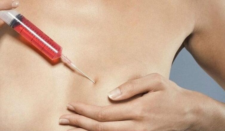 Ingrandimento del seno con iniezioni di acido ialuronico