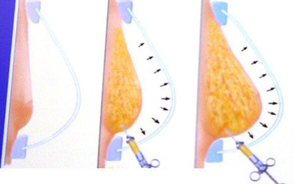 Ingrandimento del seno con grasso