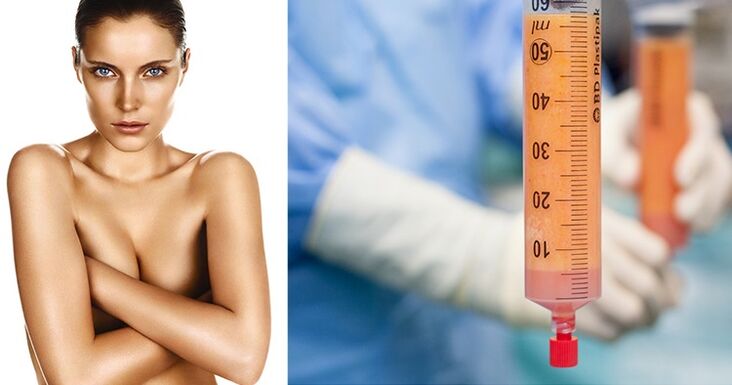 Lipofilling come metodo di aumento del seno